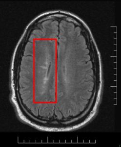 Neuroplasticity in Chronic Disease