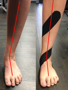 Tab Arch Taping Technique