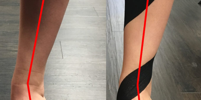 Tab Arch Taping Technique