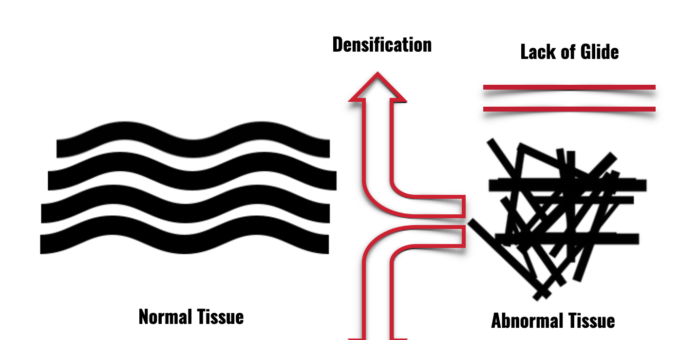 Densification v Fibrosis