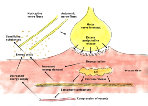 Likely Mechanisms of Dry Needling