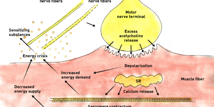 Likely Mechanisms of Dry Needling